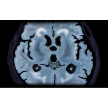 MRI Brain